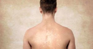 Tinea Versicolor - HealthPigeon