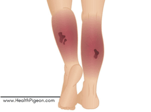 Necrotizing Fasciitis: Causes, Risk factors, Symptoms and Treatment.