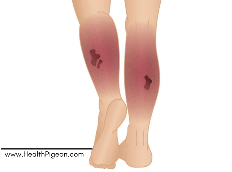 Necrotizing Fasciitis: Causes, Risk factors, Symptoms and Treatment.