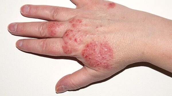 what-is-eczema